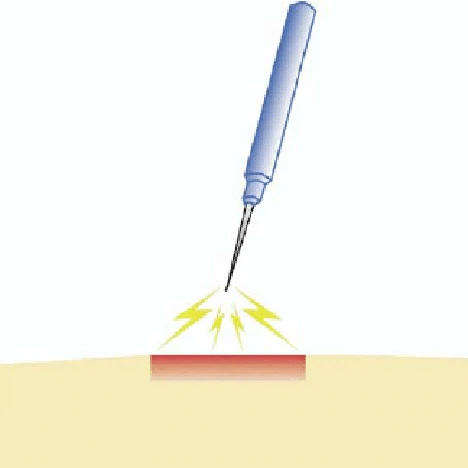 Use-of-Disposable-Tungsten-Needles-cut